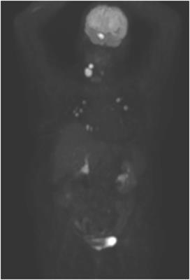 Teriparatide Replacement Therapy for Hypoparathyroidism During Treatment With Lenvatinib for Advanced Thyroid Cancer: A Case Report